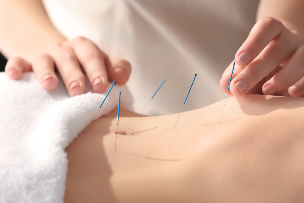 Tratamento de acupuntura sendo realizado em barriga de mulher.