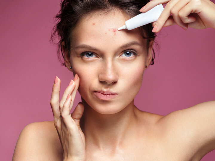Conheça os efeitos da acne em diferentes fases da vida