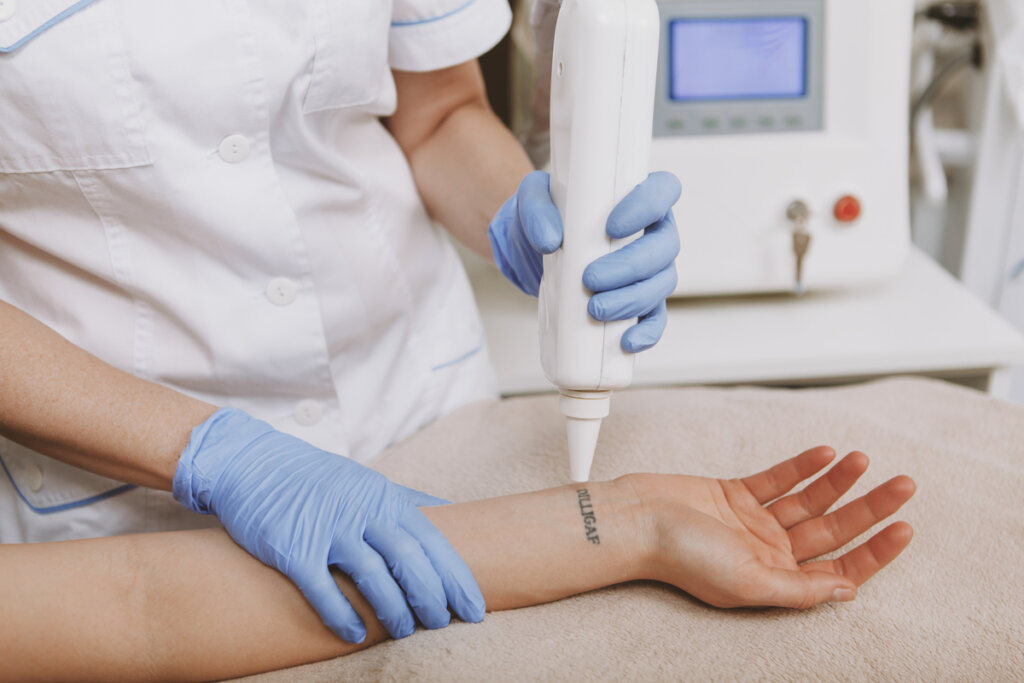Médico removendo tatuagem no braço de uma pessoa