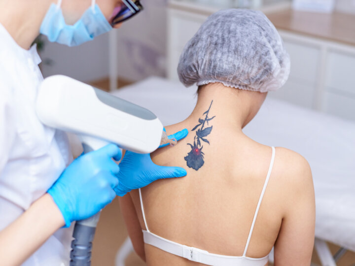 Remoção de tatuagem: entenda como funciona o procedimento