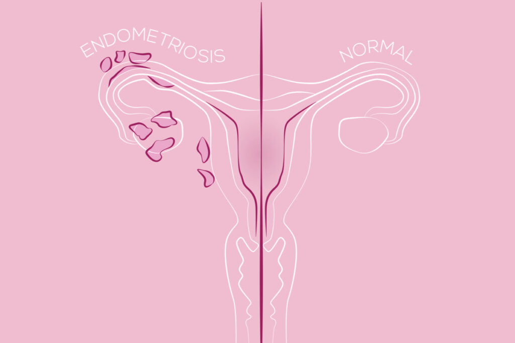 Ilustração anatômica da endometriose