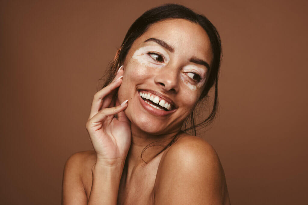 Mulher com vitiligo, sorrindo e olhando para o lado