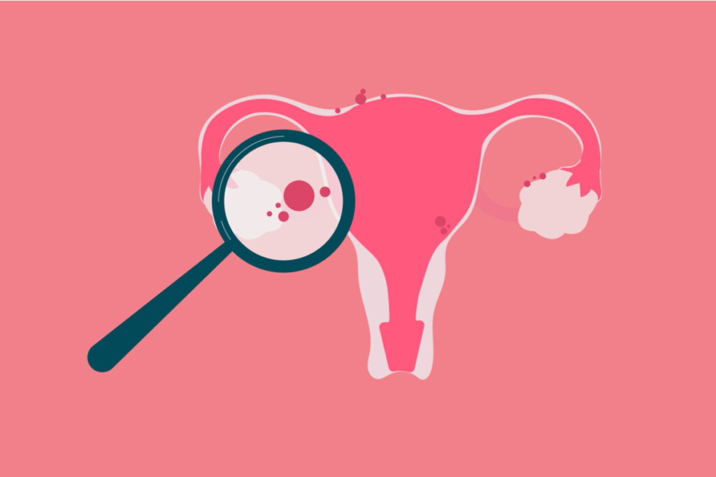 Ilustração de um útero com endometriose em tons de rosa e uma lupa em cima do útero