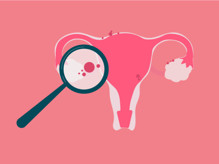 Endometriose: conheça as causas, os sintomas e os tratamentos