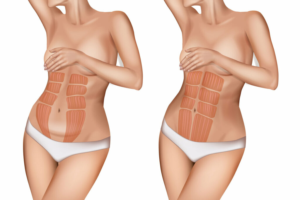 Ilustração de um corpo antes e depois da diástase abdominal