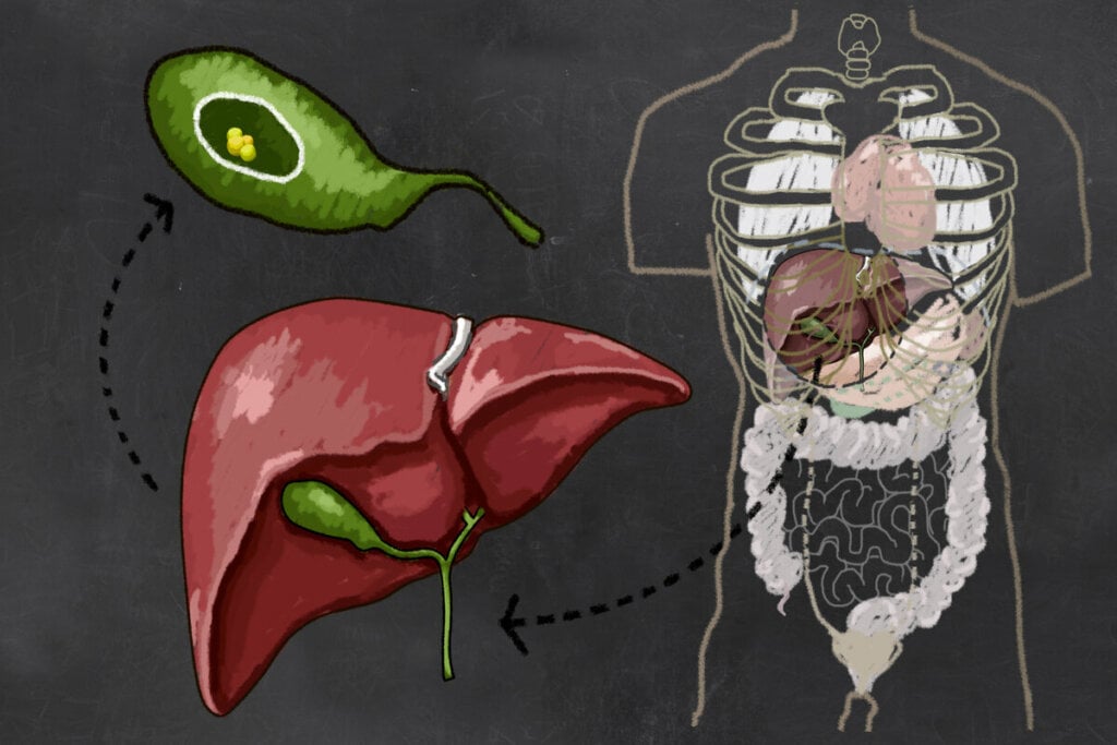 Ilustração da vesícula biliar abaixo do fígado com pedras
