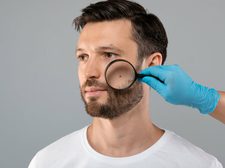 Autoexame é importante para identificar mudanças em pintas e melanomas