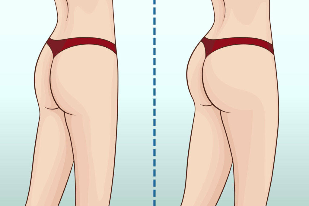 Ilustração de um bumbum antes e após procedimento estético 