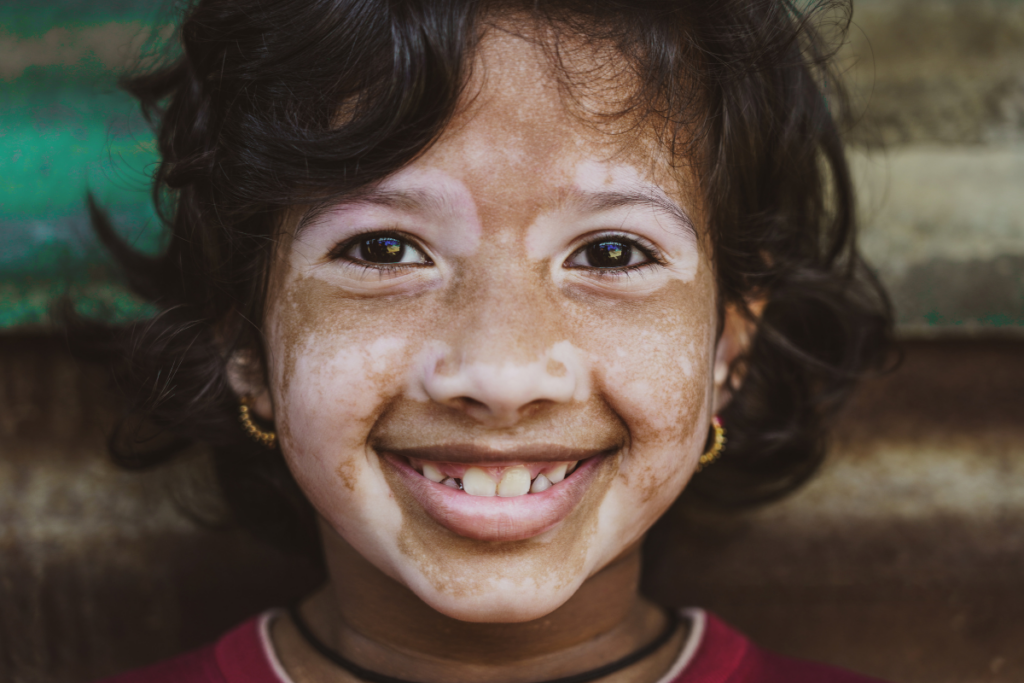 Criança sorridente com marcas de vitiligo no rosto
