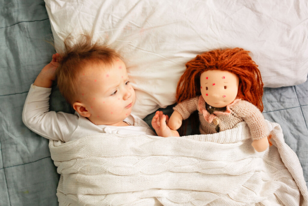 Criança com catapora deitada em cama ao lado de boneca com pintinhas vermelhas no rosto