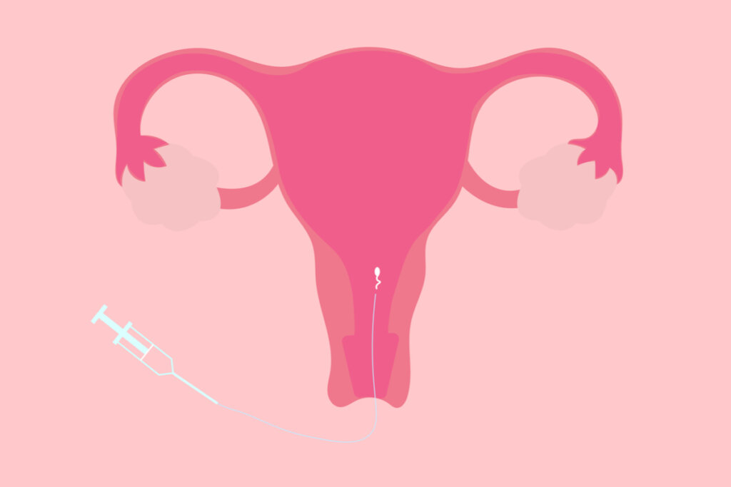Ilustração anatômica da inseminação intrauterina 