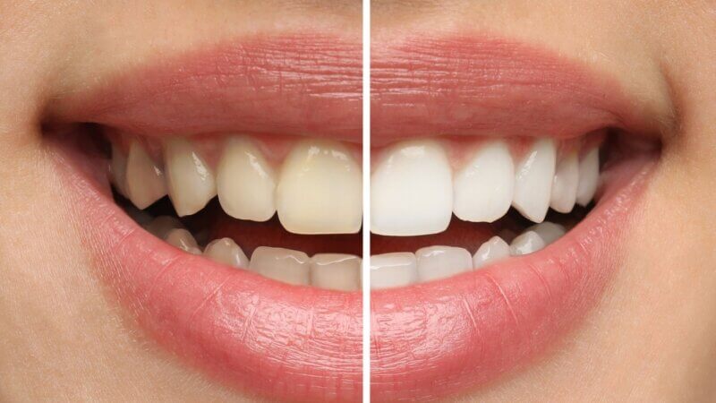 3 riscos do clareamento dental caseiro para a saúde da boca