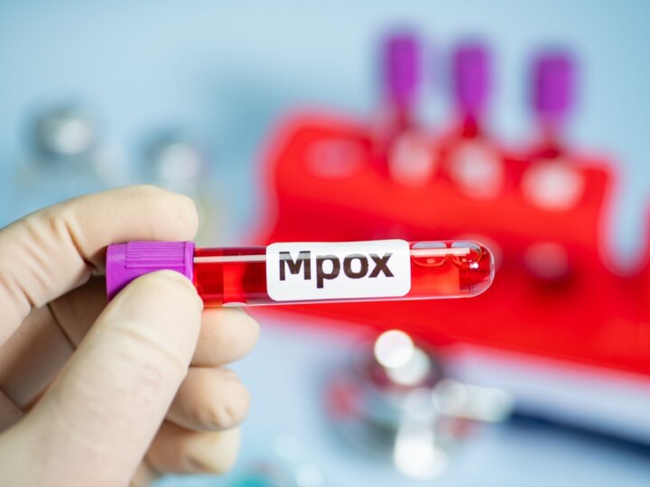 Veja os sintomas e as formas de prevenção contra a mpox