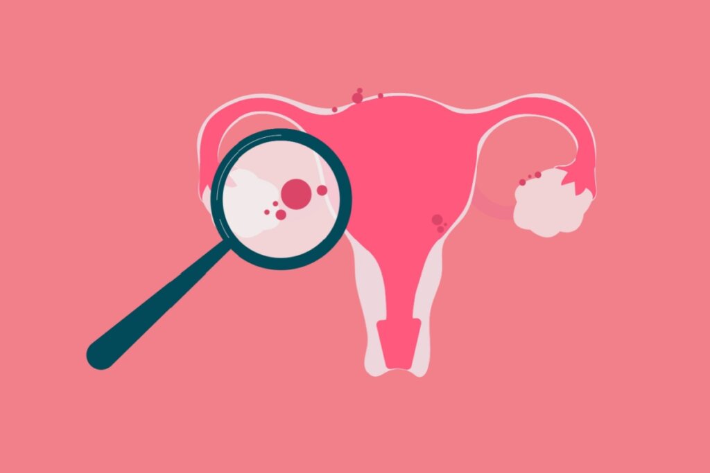 ilustração de endometriose em útero em tons de rosa