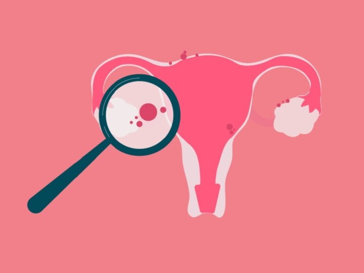 5 fatos pouco conhecidos sobre a endometriose