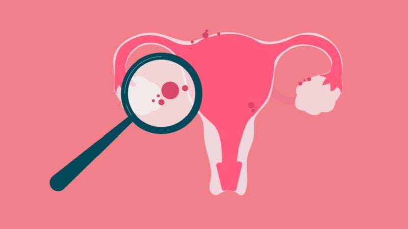 5 fatos pouco conhecidos sobre a endometriose